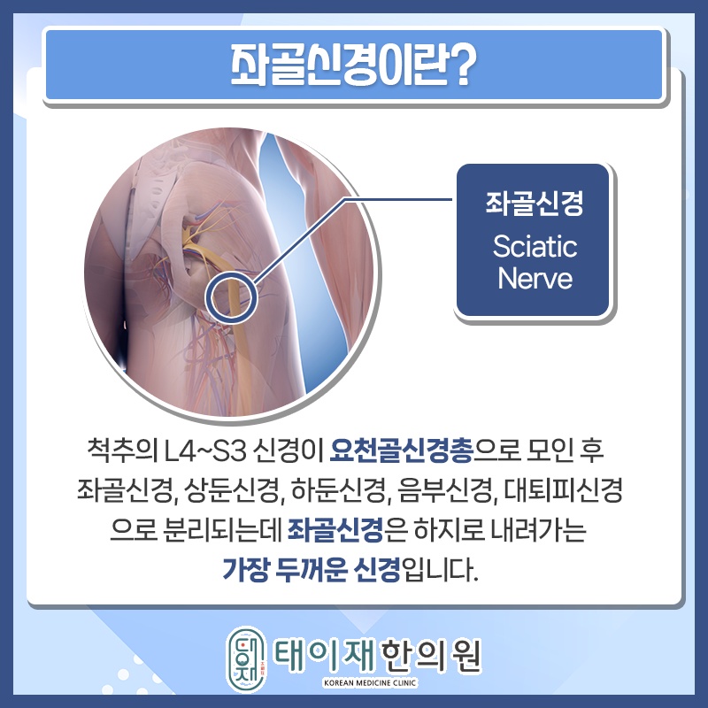 다리로 이어지는 통증, 좌골신경통과 요통의 차이