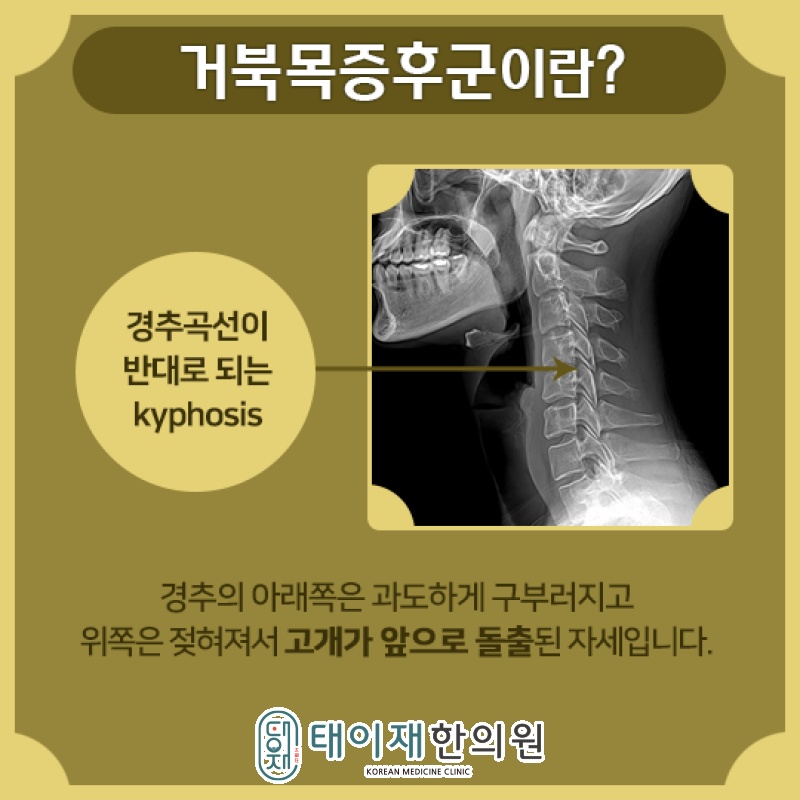 거북목증후군을 부르는 생활 습관과 목 자세 점검