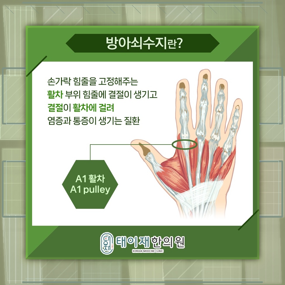 손을 자주 세게 쥐는 습관과 방아쇠수지의 연관성
