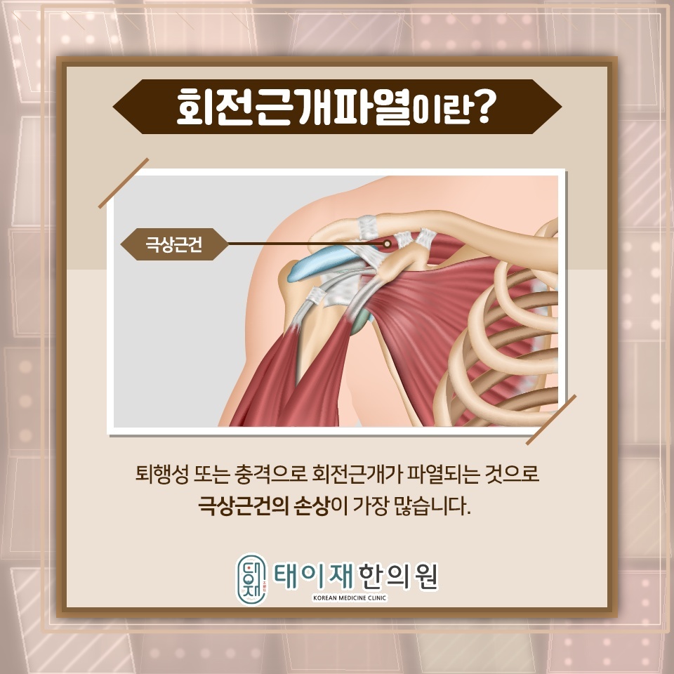 어깨 통증과 힘 빠짐으로 확인하는 회전근개파열