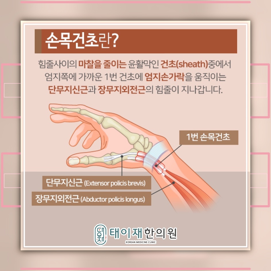붓기와 열감으로 알아보는 손목건초염의 주요 신호