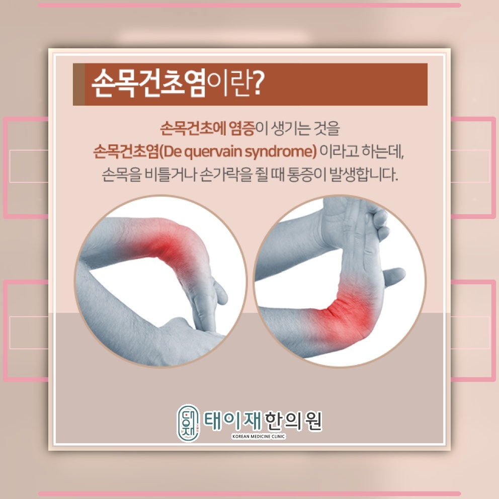 붓기와 열감으로 알아보는 손목건초염의 주요 신호